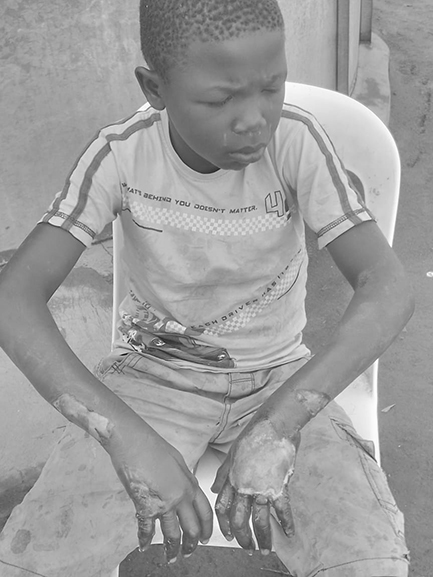 The 10-year-old boy whose hands were allegedly burned by his mother over the suspected theft of sh10,000 in Ngora District. (Courtesy Photo/Police)