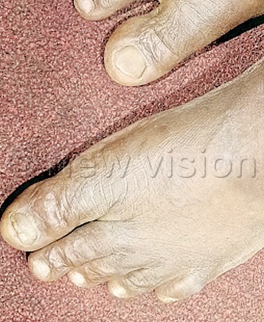 Matege's left big toe, whose nail was plucked out during attack.