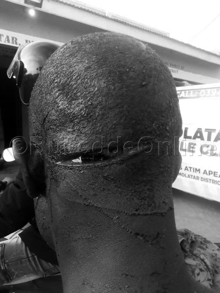 Ekiwundu Ekiri Ku Mutwe Gwe Baatemye. Wano Baabadde Bamutwala Mu Ddwaaliro.