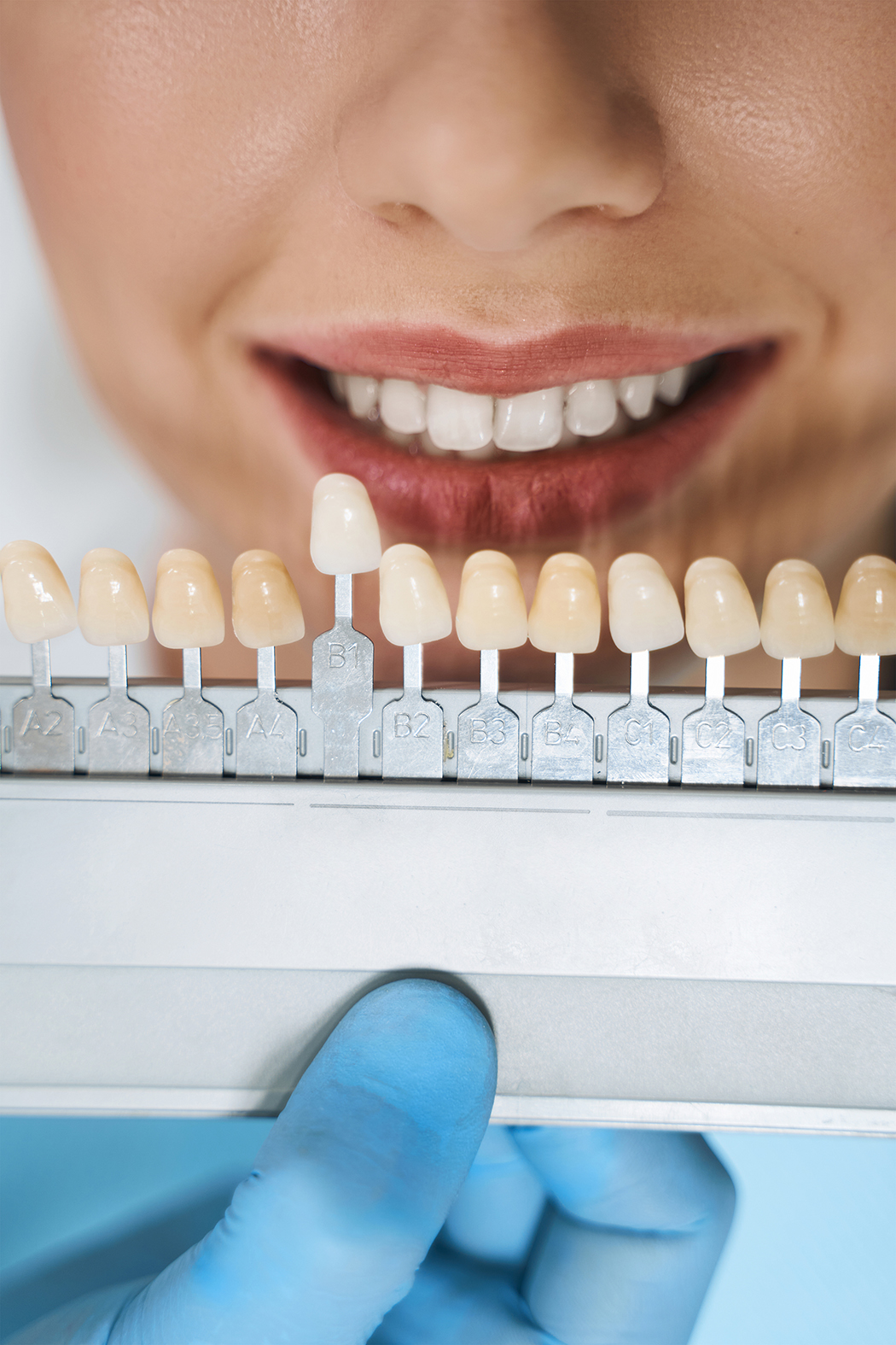 Teeth veneer cost in Turkey New Vision Official