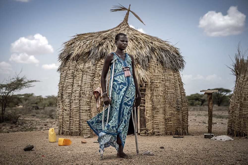 Mycetoma patient Joyce Loote Lokonyi, 29, who had her foot amputated due to complications from the infection, stands in front of the hut where she lives in the village of Kapokor on March 31, 2025. (Credit: AFP)