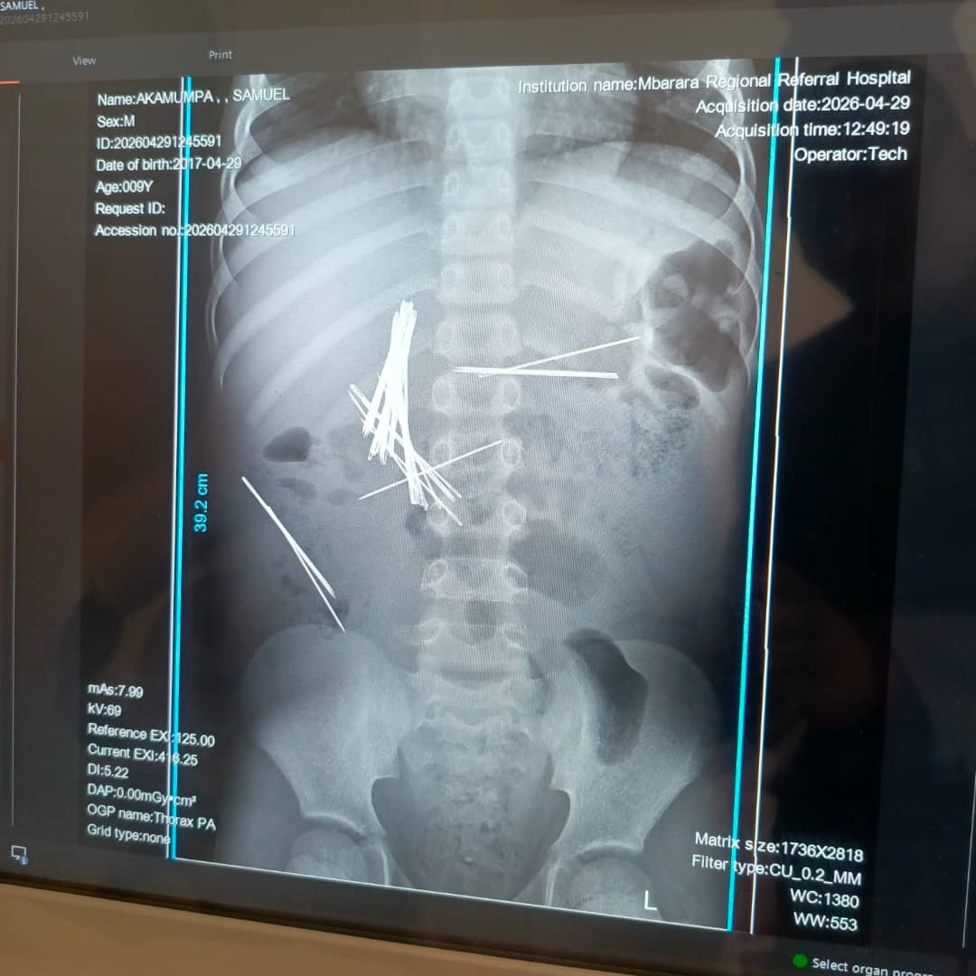 Doctors said the boy had endured persistent stomach pain for nearly eight months and had been taken to several clinics without improvement before scans eventually revealed multiple metallic objects lodged inside his abdomen.