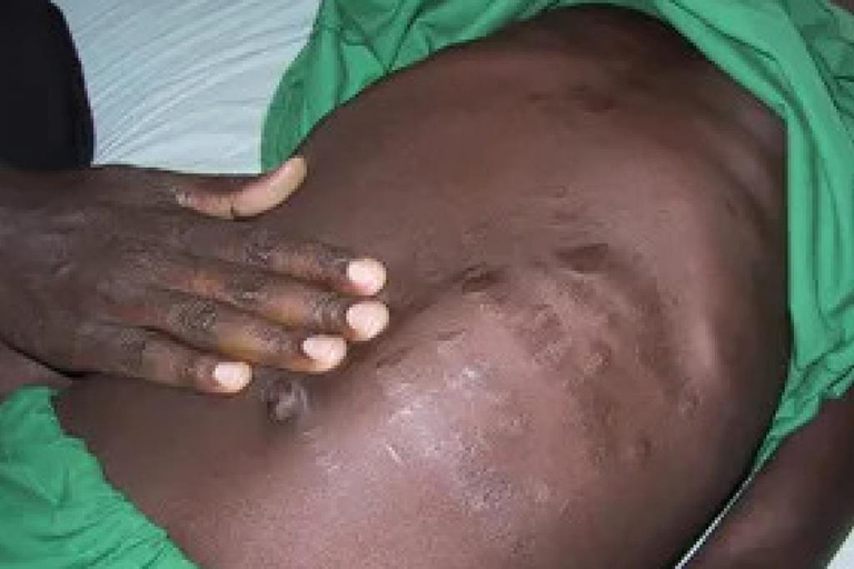 A child with leishmaniasis. (Courtesy). 