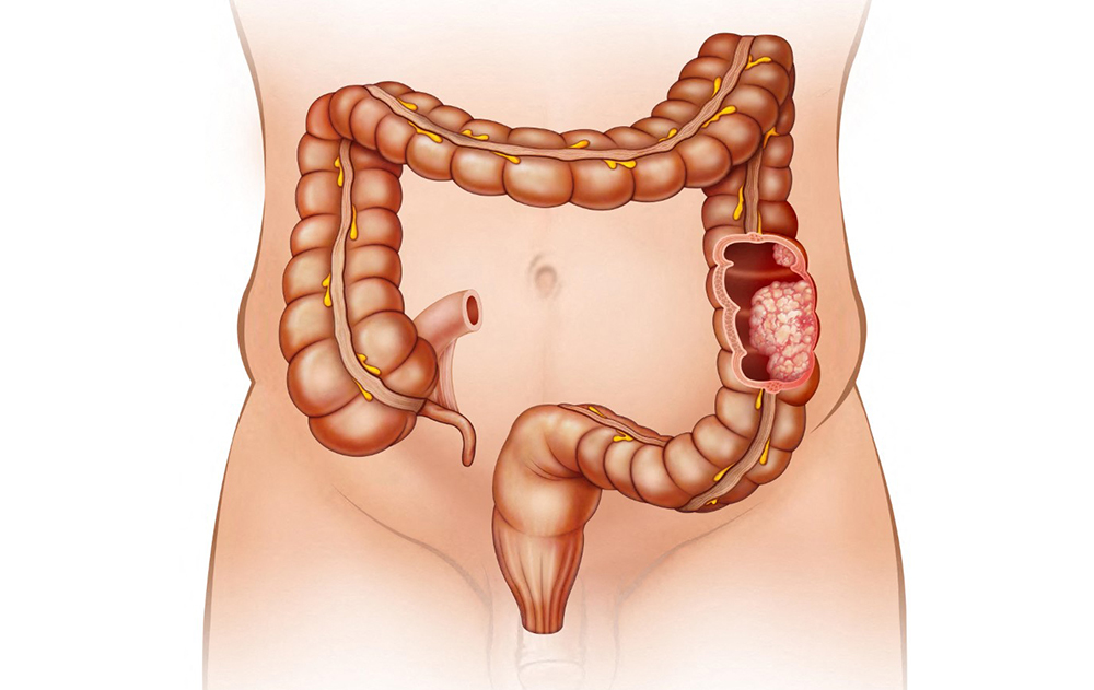 Illustration of a human abdomen showing the large intestine with a malignant colon tumour, a condition originating in the colon or rectum. (AFP)