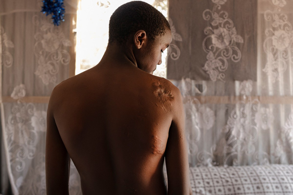 The teenage son of Mary Milka Tiren, 40 (not pictured), shows scars on his body from a crocodile attack on Lake Bogoria, a decade after he lost his father to another attack by a Hippopotamus in the wake of increased proximity of wildlife to human settlements around the rising lake in Marigat sub-county, Baringo county on July 28, 2026. (Photo by Tony KARUMBA / AFP)
