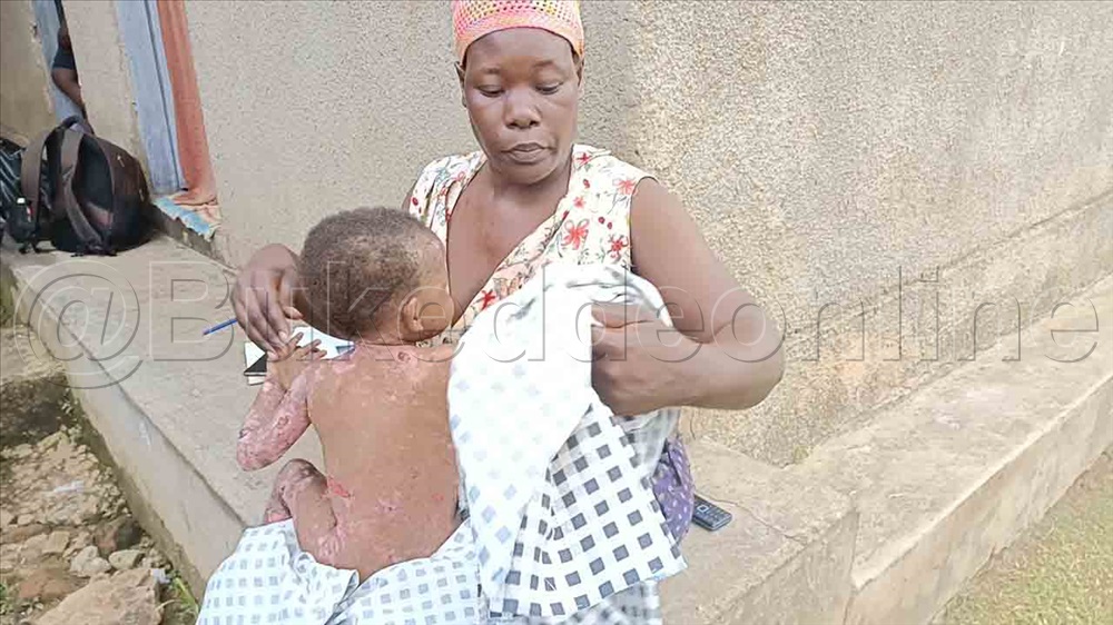 Omwana Nga Yenna Ajjudde Amabwa Omubiri Gwonna.